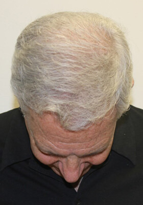 hair transplant photos