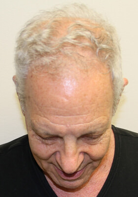 hair transplant photos