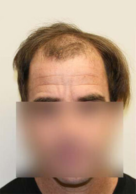 Dr Brett Bolton Patient Photos  - One Procedures