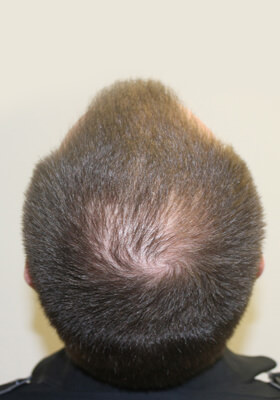 hair transplant photos