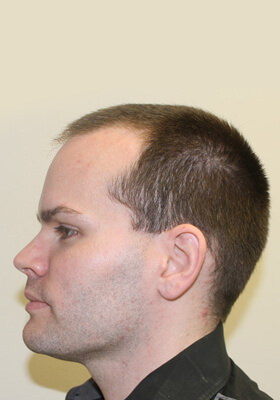 hair transplant before after Photos