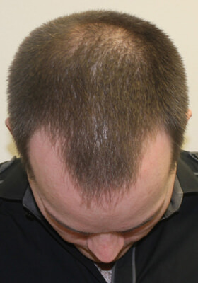 hair transplant photos