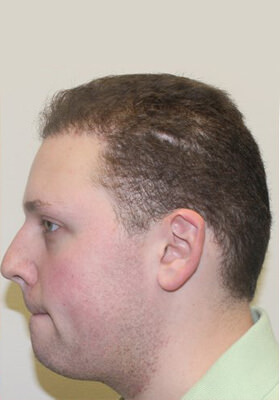 hair transplant before after Photos