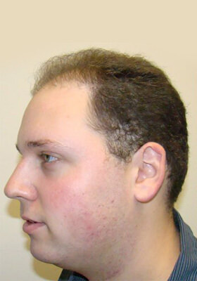 hair transplant photos