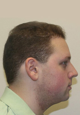 hair transplant before after Photos