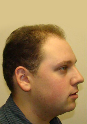 hair transplant photos