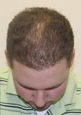 hair transplant photos