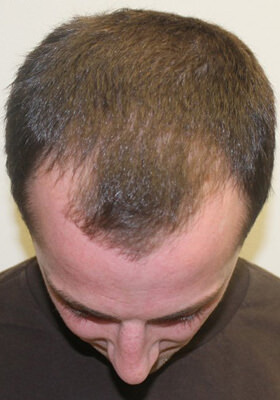 hair transplant photos