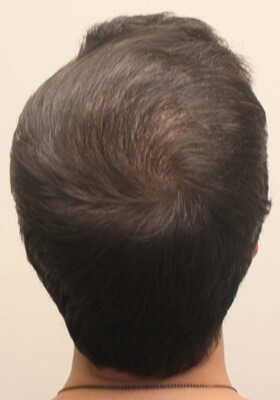 hair transplant photos