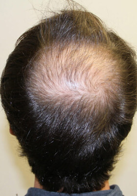 hair transplant photos