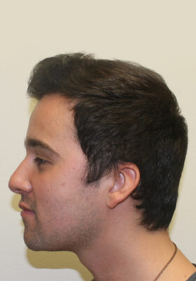 hair transplant before after Photos