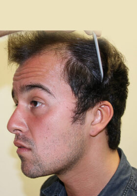 hair transplant before after Photos