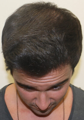 hair transplant before after Photos