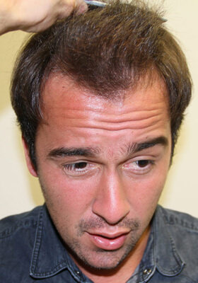 hair transplant before after Photos