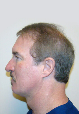 hair transplant photos