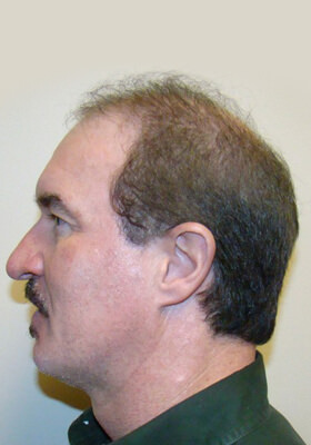 hair transplant photos