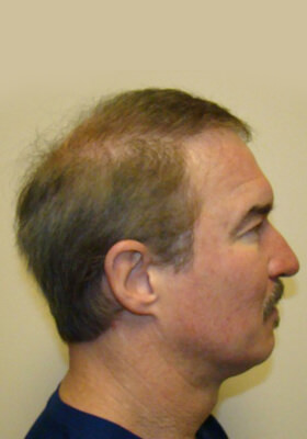 hair transplant before after Photos