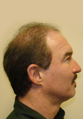 hair transplant photos