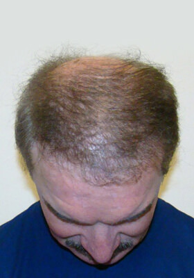 hair transplant photos