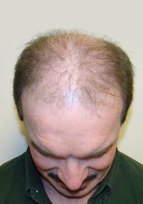 hair transplant photos