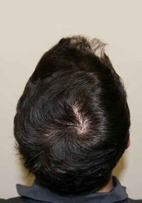 hair transplant photos