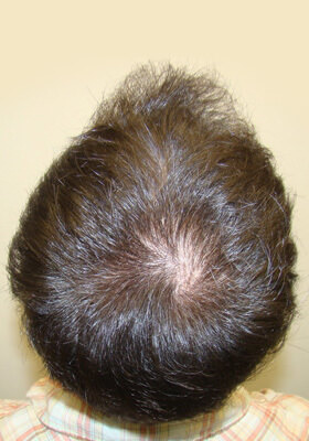 hair transplant photos