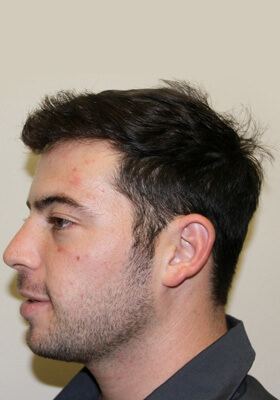 hair transplant photos