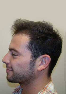 hair transplant photos