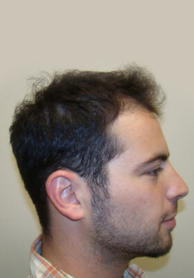 hair transplant before after Photos