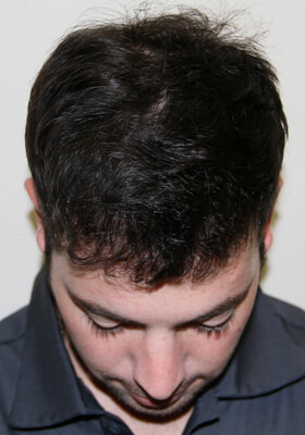 hair transplant photos