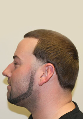 hair transplant before after Photos