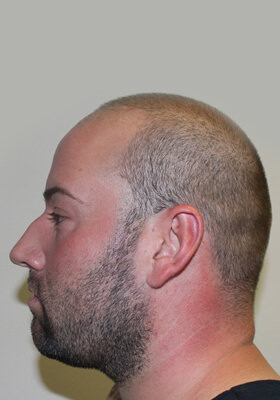 hair transplant before after Photos