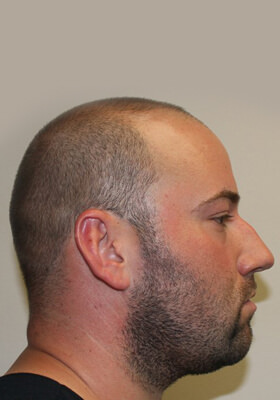 hair transplant photos