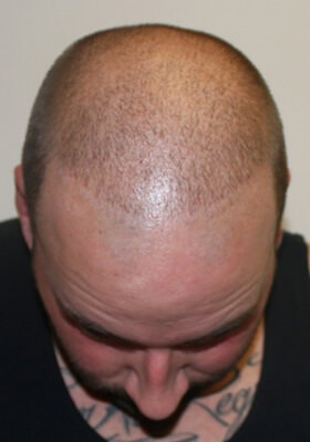 hair transplant before after Photos