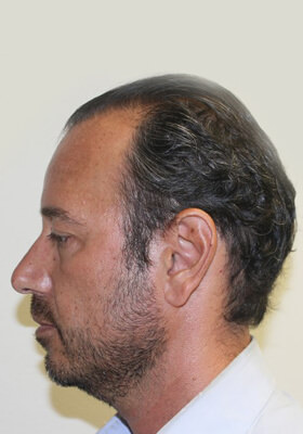 hair transplant before after Photos