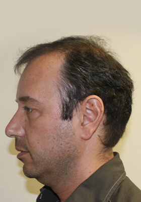 hair transplant photos