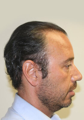 hair transplant before after Photos