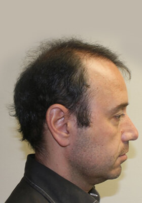 hair transplant before after Photos