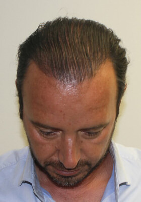 hair transplant before after Photos