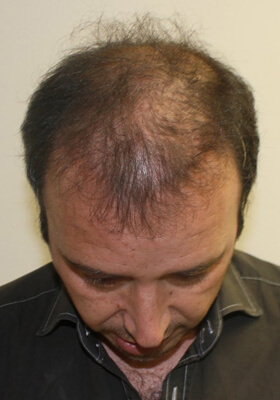 hair transplant photos