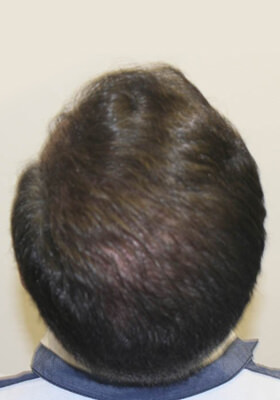 hair transplant before after Photos