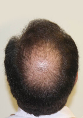 hair transplant before after Photos