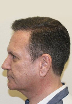 hair transplant before after Photos