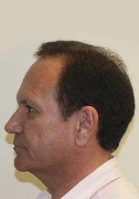 hair transplant before after Photos