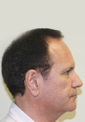 hair transplant photos