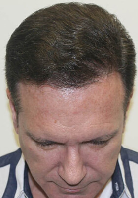 hair transplant before after Photos