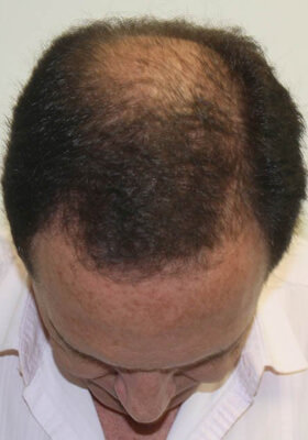 hair transplant before after Photos