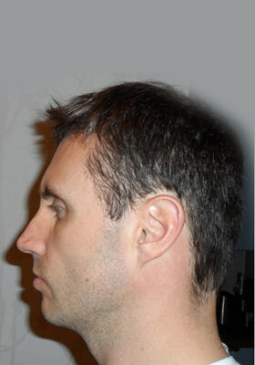 hair transplant photos