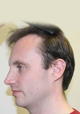 hair transplant before after Photos