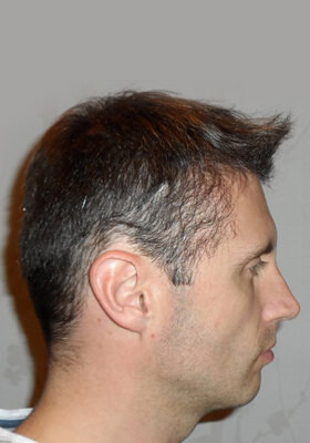 hair transplant before after Photos